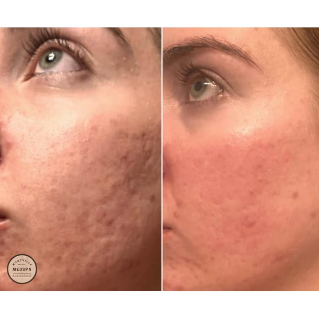 Before and after: vivace rf microneedling