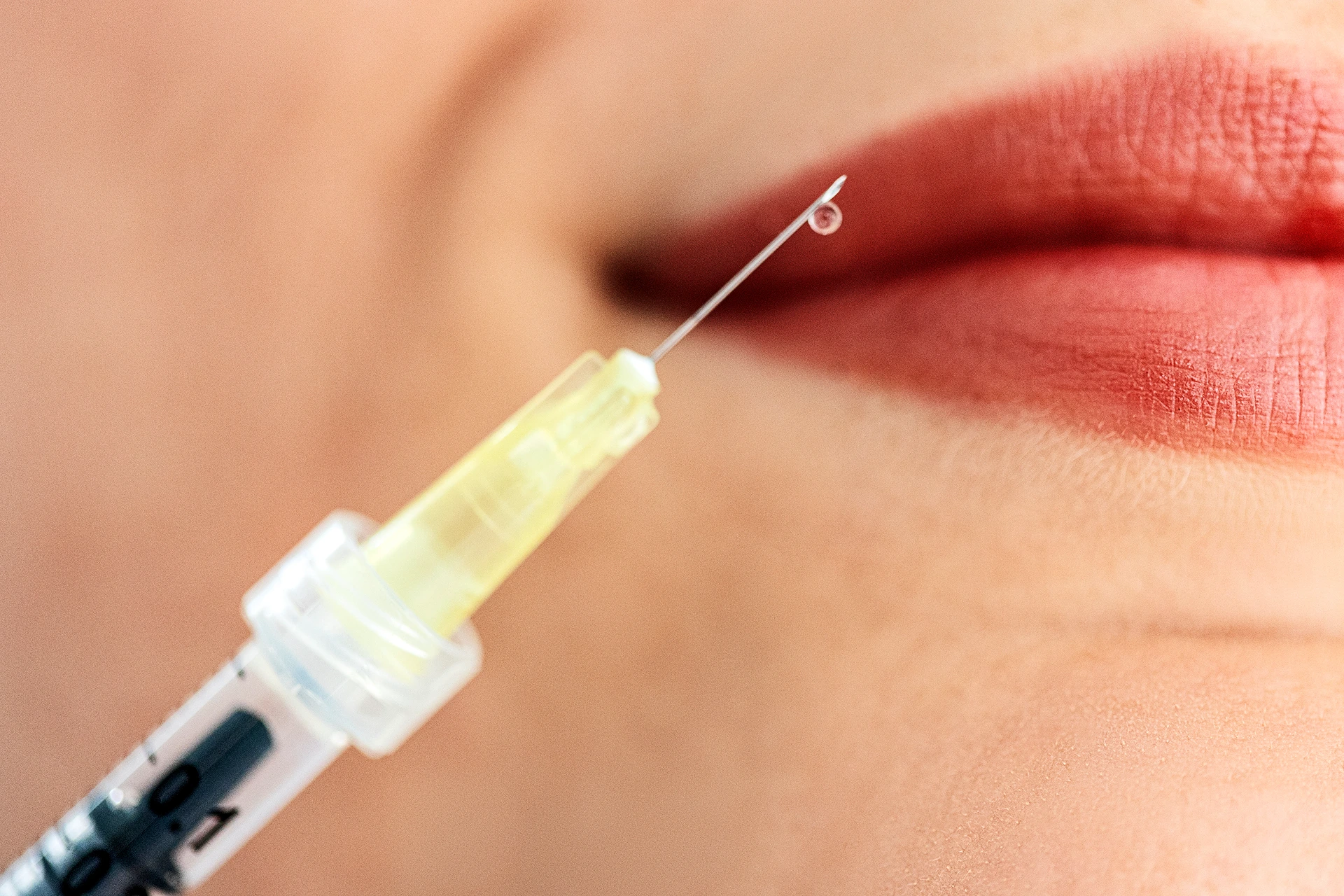 The Ultimate Guide to Hyaluronic Acid Lip Fillers