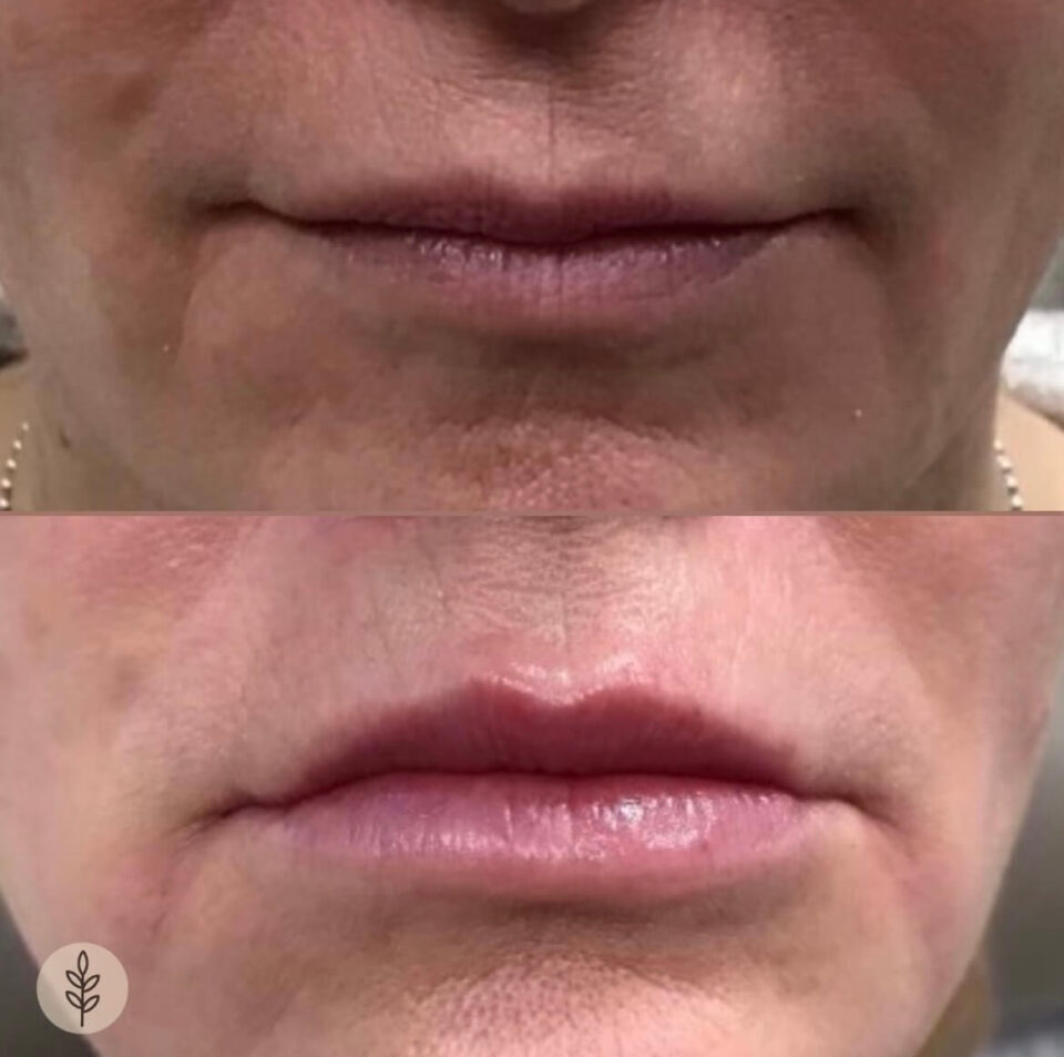 Before And After Lip Injections, Montville NJ Montville Med