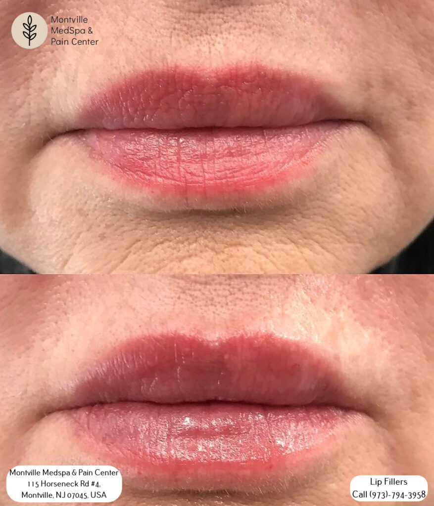 lip filler treatments at Montville Medspa