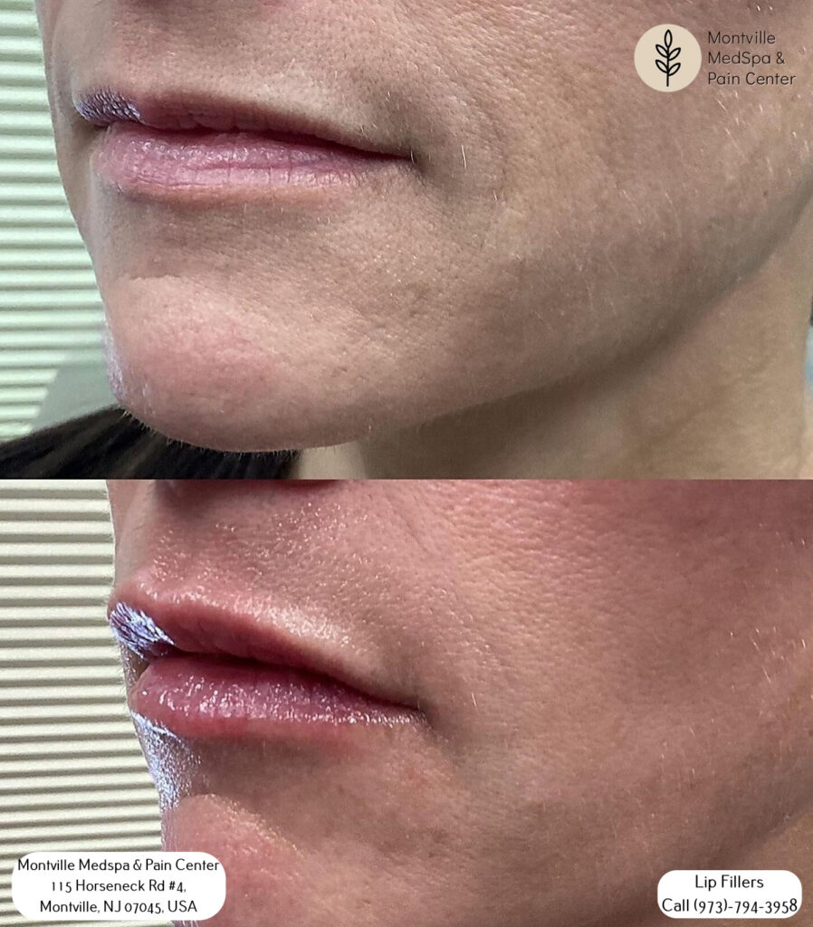 lip filler treatments at Montville Medspa 