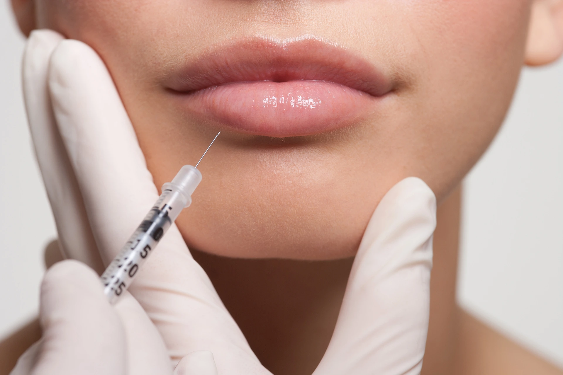 Cupids Bow Lip Filler: A Guide To Perfect Lips