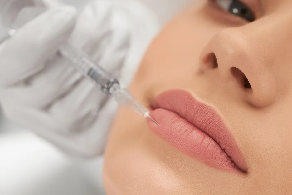 a woman underwent a 2ml lip filler treatment