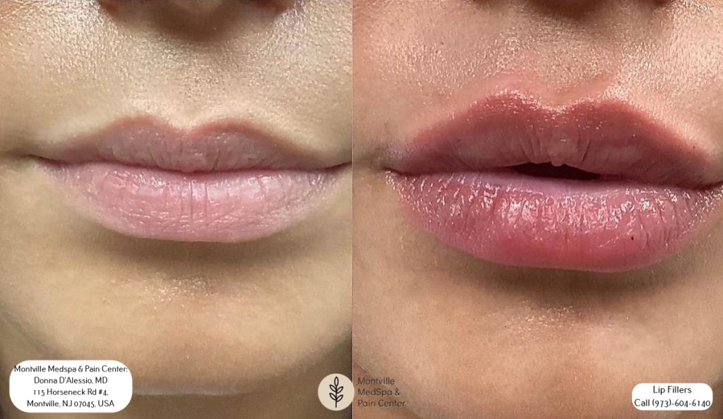 lip filler treatments at Montville Medspa