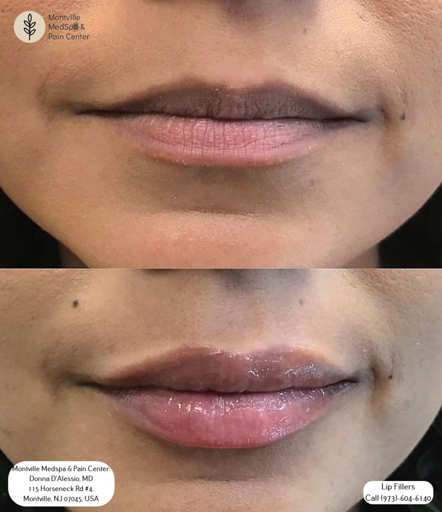 lip fillers for wrinkles treatments at Montville Medspa & Pain Center