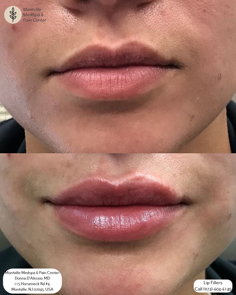 lip filler treatments at Montville Medspa & Pain Center clinic