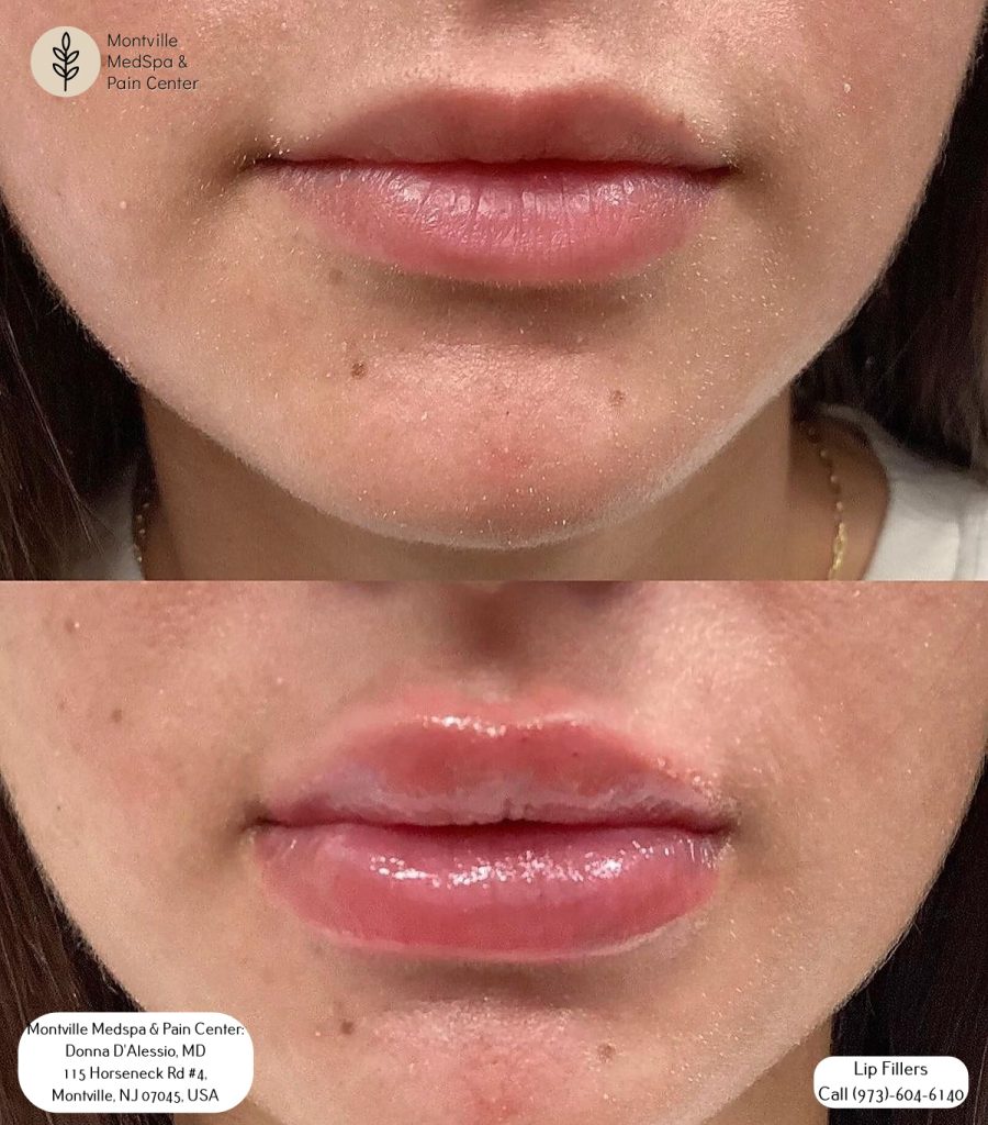 subtle lip filler at Montville Medspa