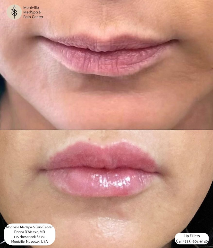 versa lip filler treatment at Montville Medspa