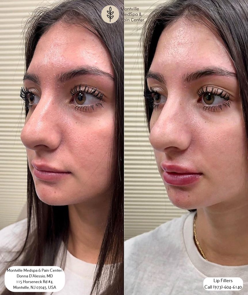 lip filler treatments at Montville Medspa