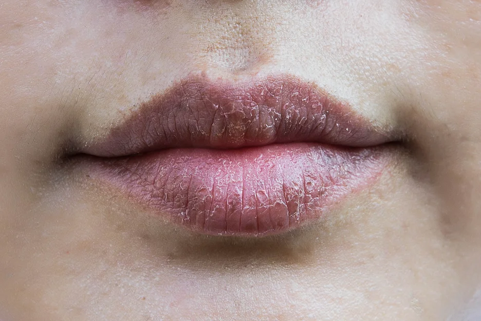 lip peeling after filler