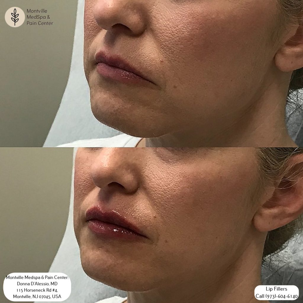 lip filler treatments at Montville Medspa & Pain Center