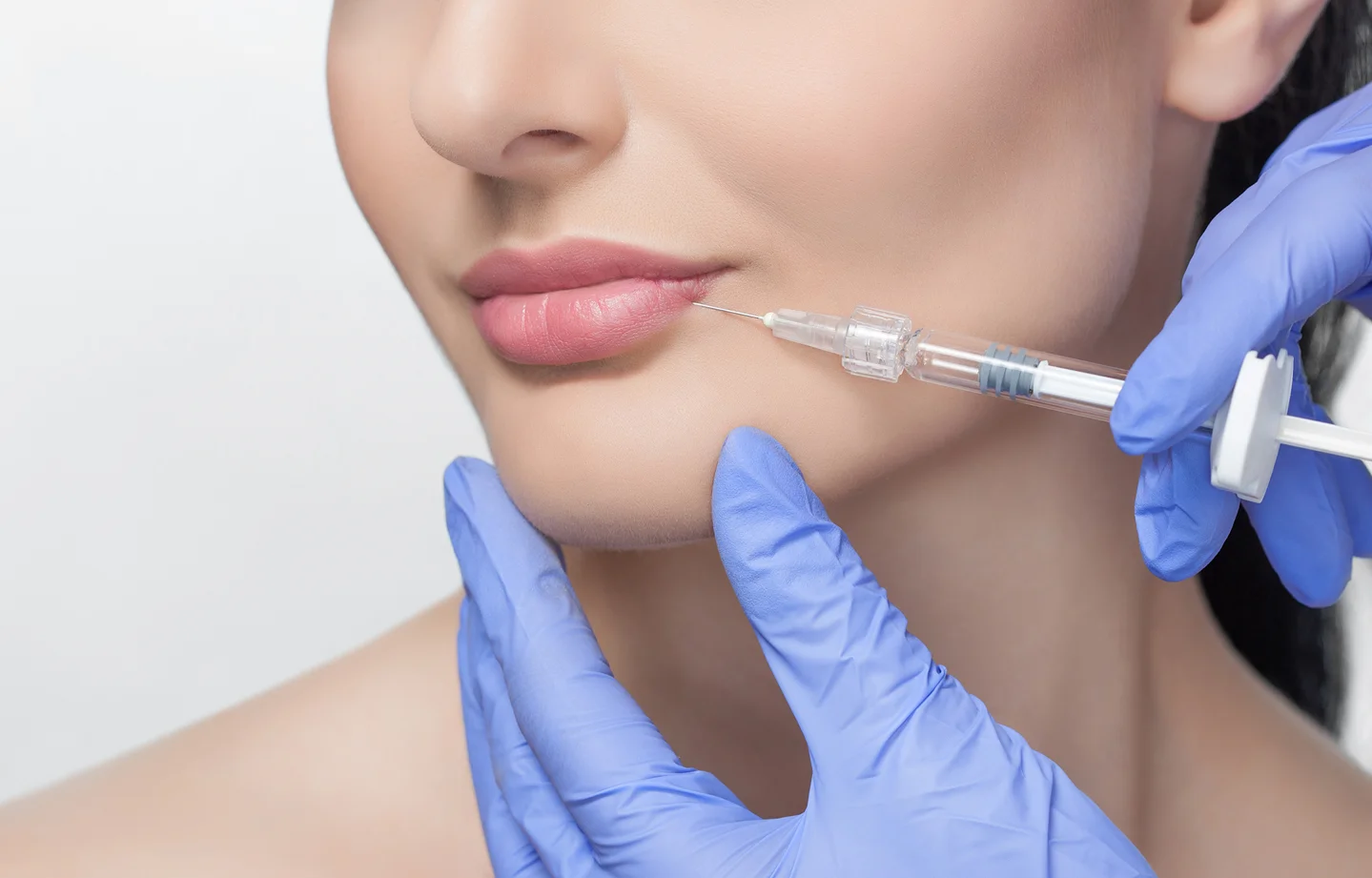 a woman underwent lip filler procedure