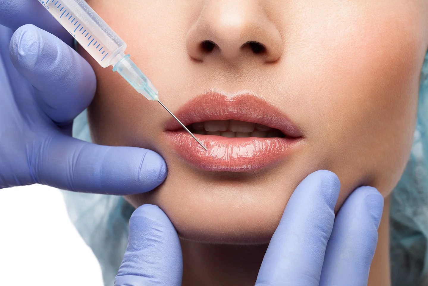 radiesse lip fillers